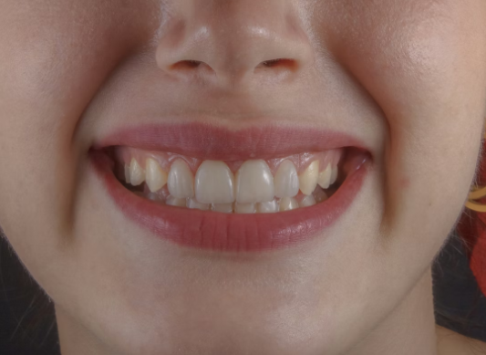 Safe and Effective Options for Teeth Whitening – Avoiding Common Mistakes